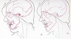 Superimposed outlines of Mrs. Ruxton and two skulls for comparison, 1935