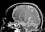 This MRI cross section shows the wound track through the brain stem and the cerebellum (see arrow), 2003