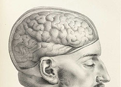 Lithograph of head of French soldier facing right with brain exposed.